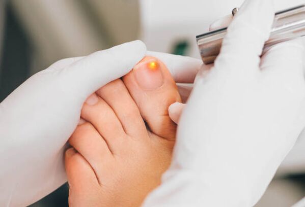 Laser treatment for fungus on toenails