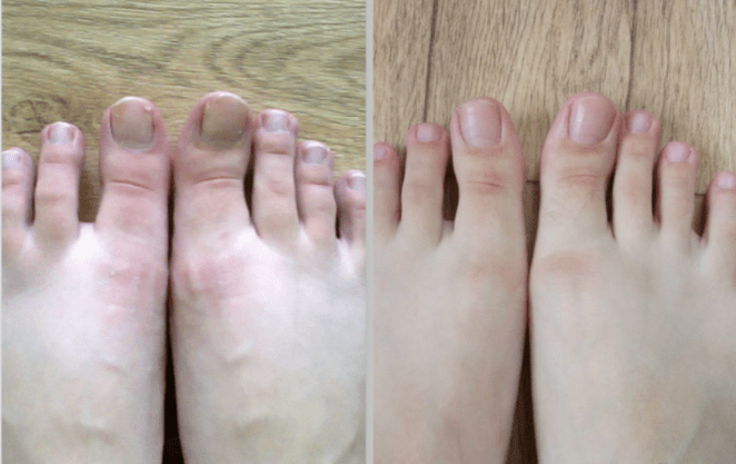 before and after treatment of toenail fungus