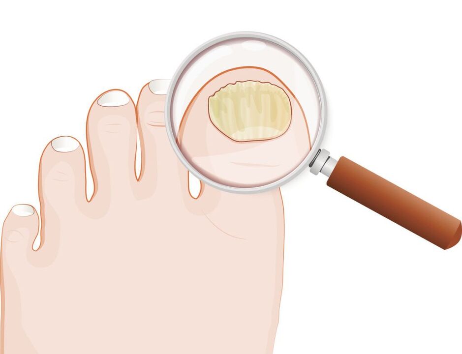 Signs of toenail fungus