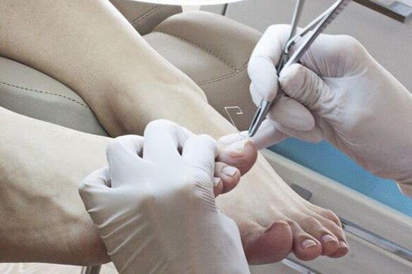 Treatment of nail fungus by a doctor