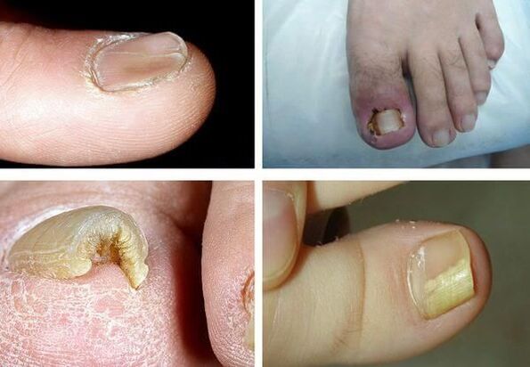 What does nail fungus look like 