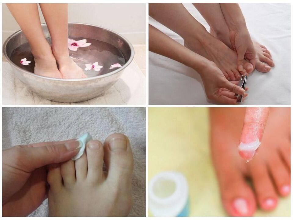 Treatment of nail fungus