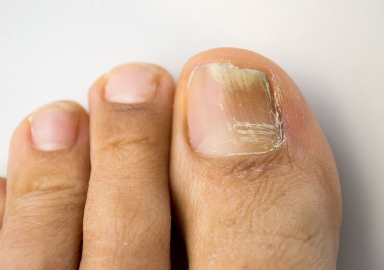 Nail fungus on big toe