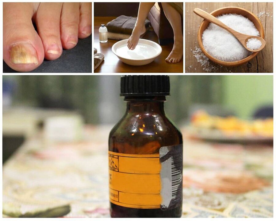 Baths against nail fungus