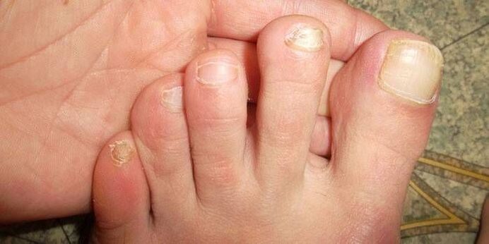 Why is nail fungus dangerous 