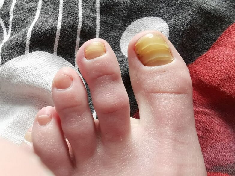 Toenail fungus