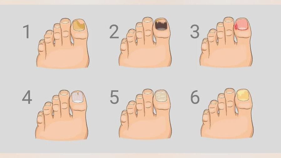 Main symptoms of athlete's foot