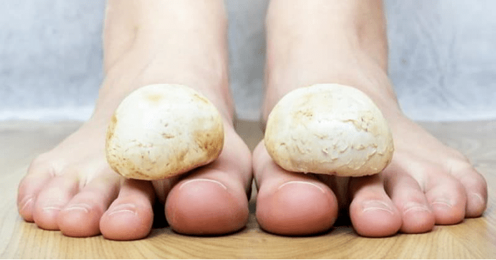 Fast treatment of mushrooms on the legs at home