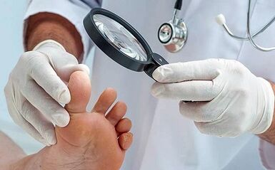 How to get rid of your nail fungus