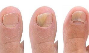Development phases of the mushroom on the thumb of the leg