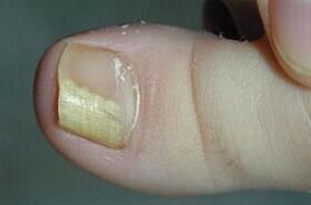 The reasons for the appearance of the mushroom on the thumb of the leg