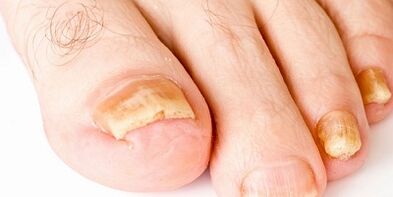 How and how to heal nail fungus