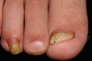 Micose of nails on the legs