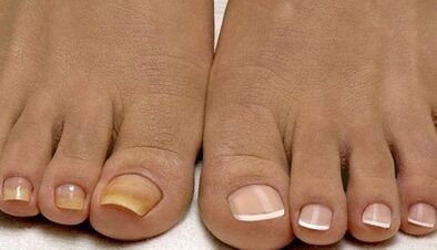 The causes of the appearance of the mushroom on the nails