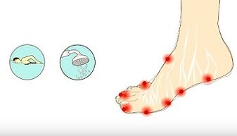 Causes of fungus on toes