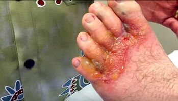 Symptoms of a fungus on the toes