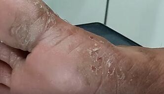 Types and forms of fungi on the toes