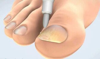 Onychomycosis scratch collection
