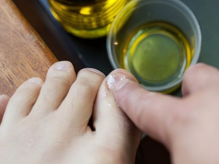 Apply medicated oil to nails affected by fungus