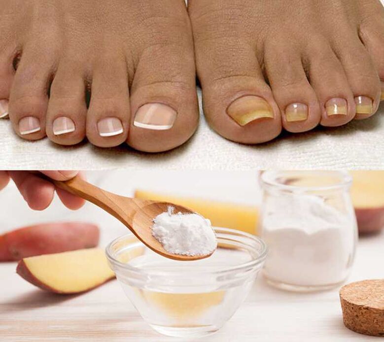 Soda for treating nail fungus
