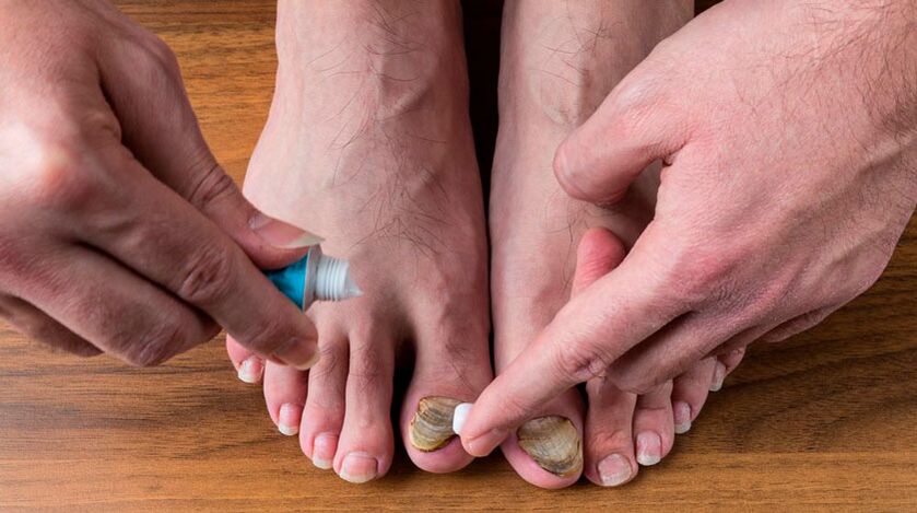 Applying an antifungal cream to toenails to treat onychomycosis